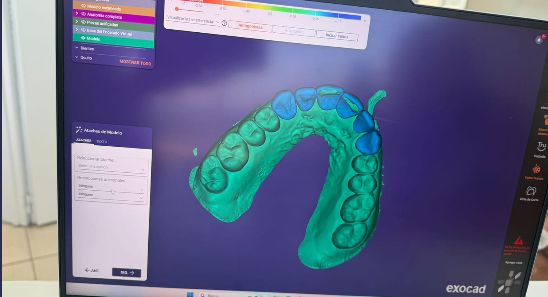 Escaneo intraoral